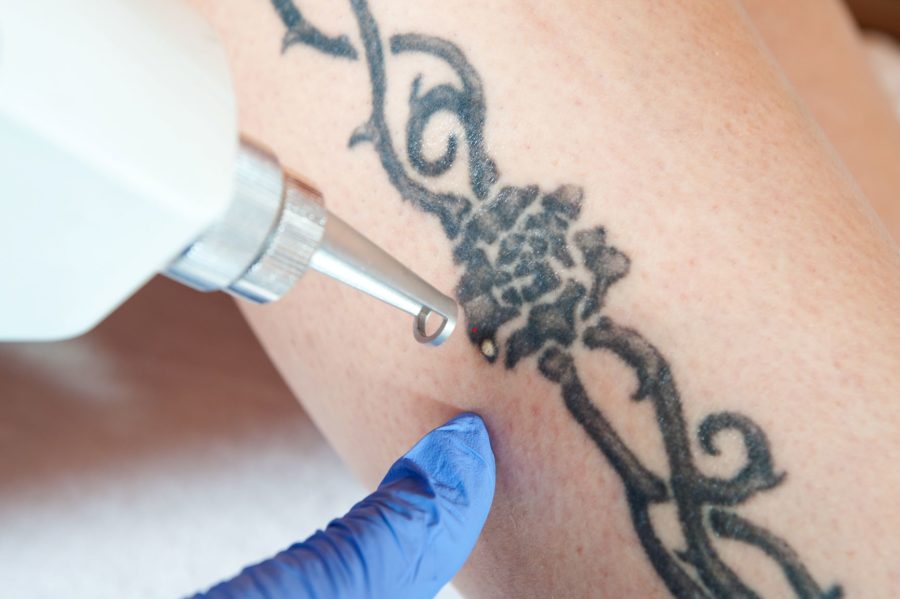 Tattoo Removal Service