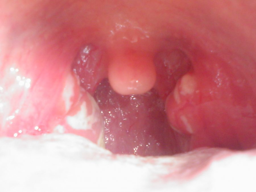 Streptococcal_pharyngitis_1