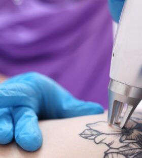 Tattoo Removal