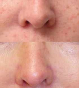 how to remove pigmentation from face permanently at home