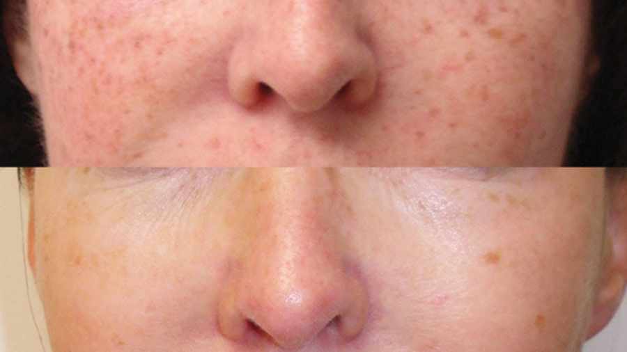 how to remove pigmentation from face permanently at home