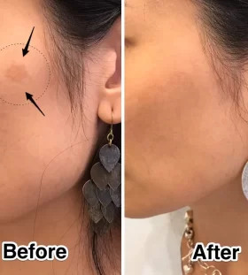 pico-q-laser-before-and-after
