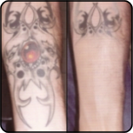 Tattoo Concealer Result Picture